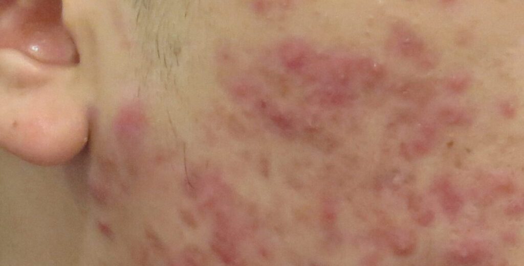 暗瘡 - 香港皮膚科醫生 - SkinRight Skin Surgery and Laser Centre 健衛皮膚手術及激光中心