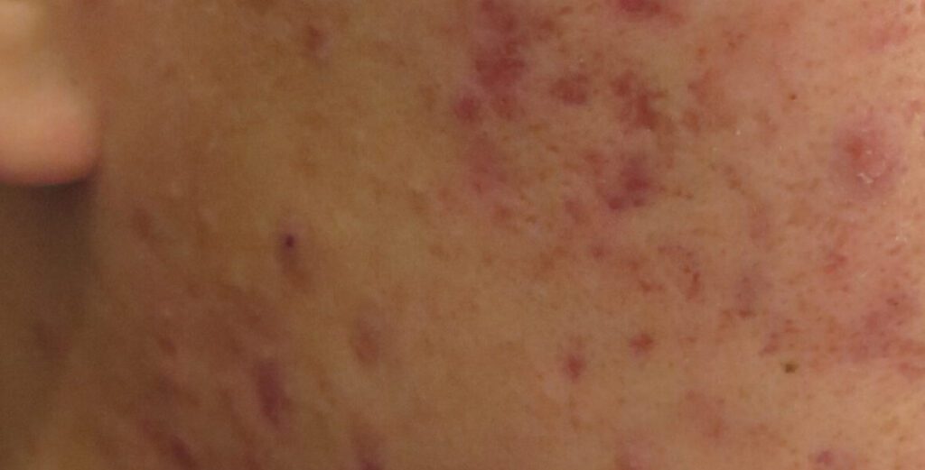 暗瘡 - 香港皮膚科醫生 - SkinRight Skin Surgery and Laser Centre 健衛皮膚手術及激光中心