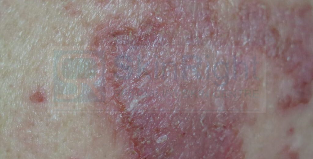 濕疹/皮膚炎 - 香港皮膚科醫生 - SkinRight Skin Surgery and Laser Centre 健衛皮膚手術及激光中心