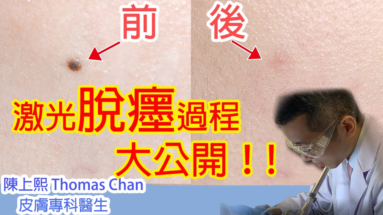 皮膚專科陳上熙醫生公開脫癦過程
