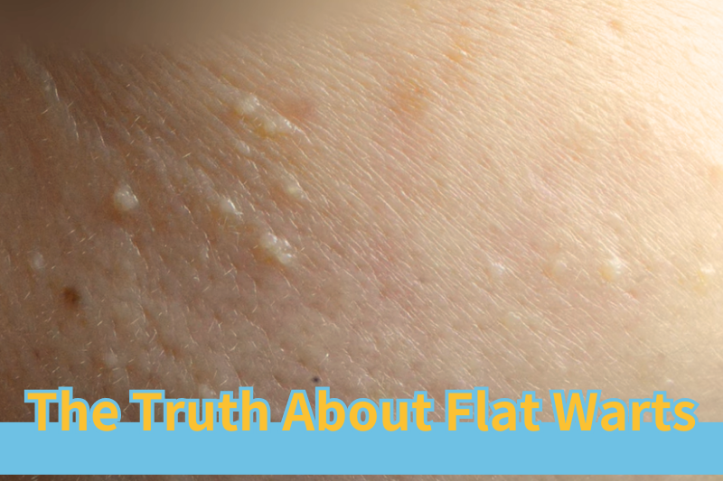 The Truth About Flat Warts