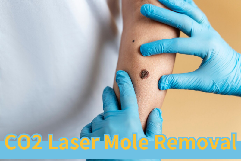 CO2 Laser Mole Removal