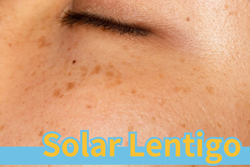 How to Combat Solar Lentigo?