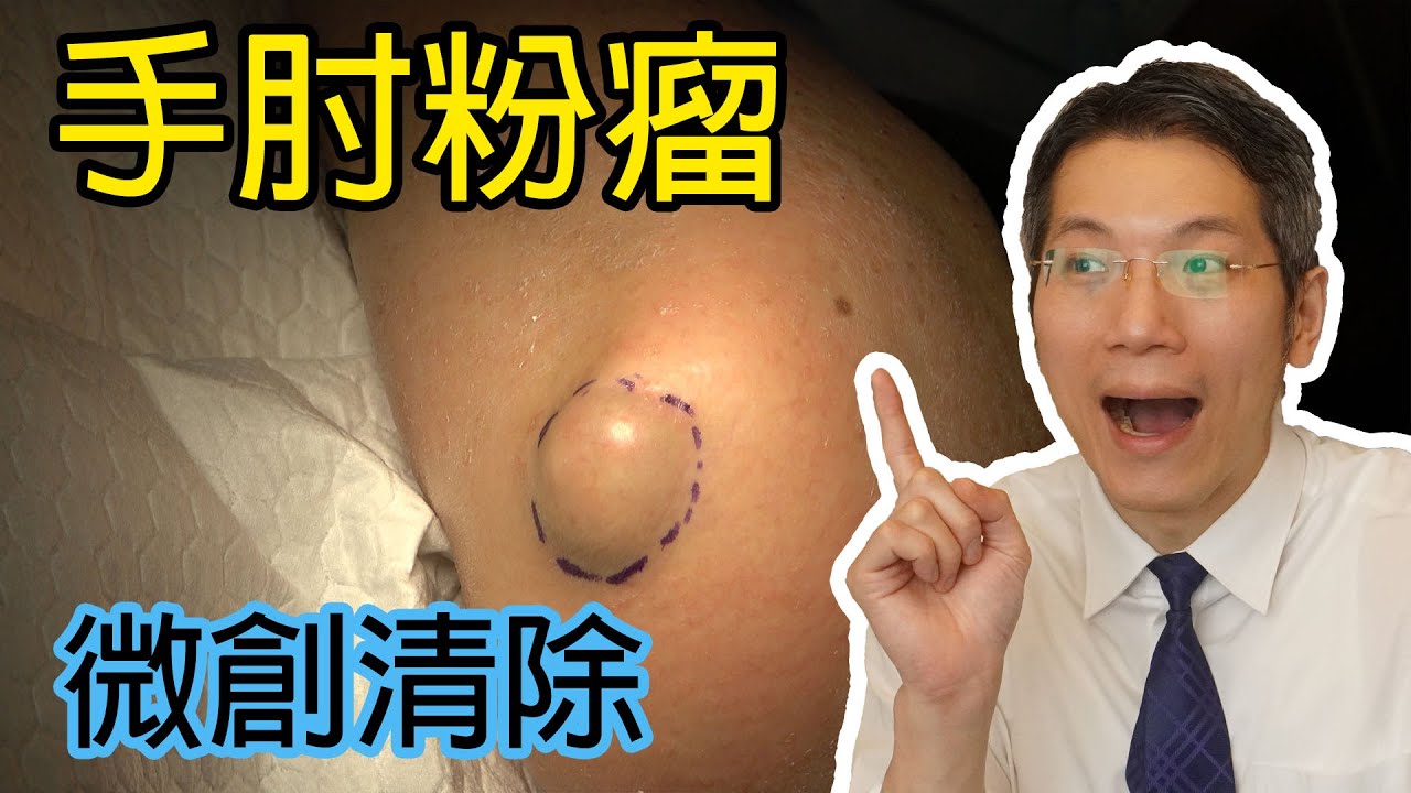 手肘粉瘤微創清除