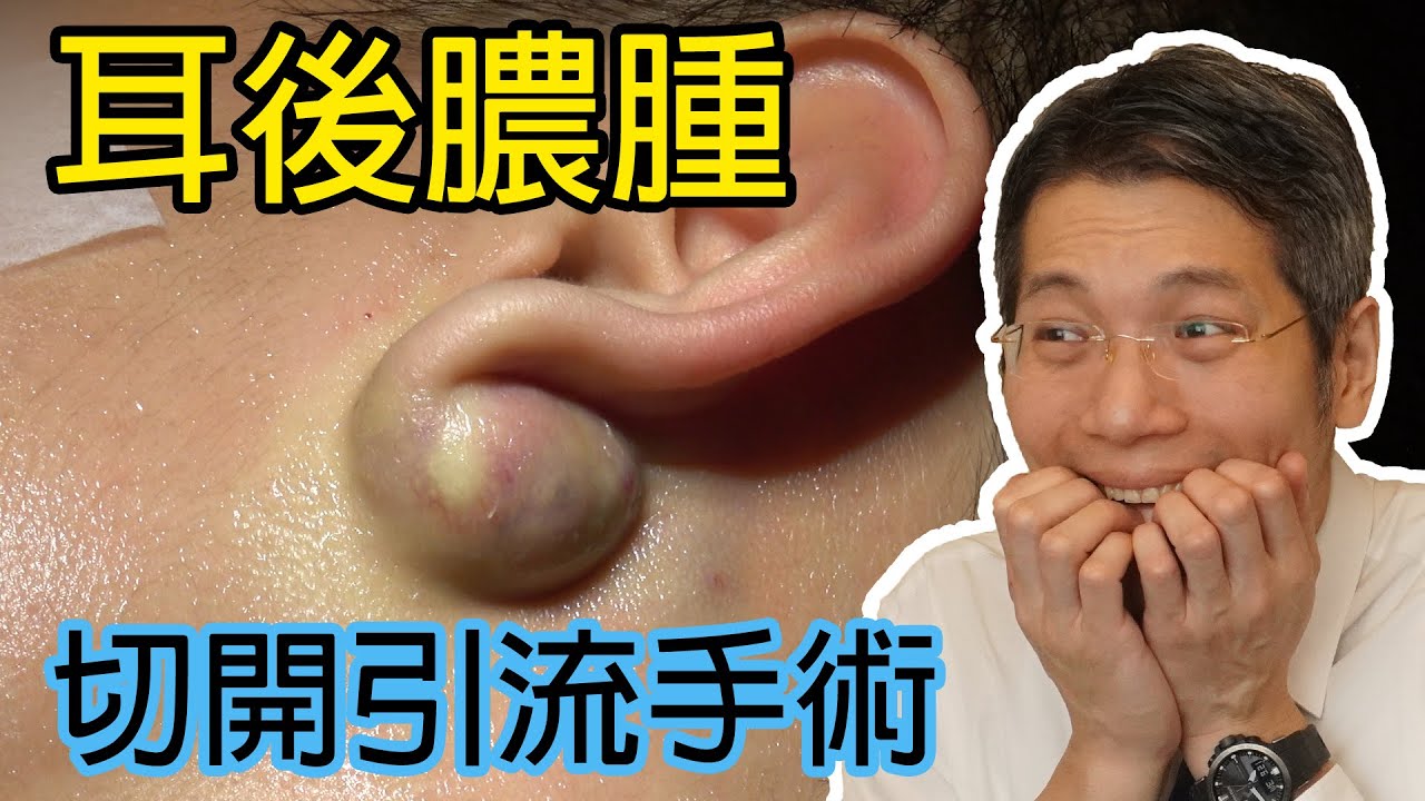 耳後膿腫