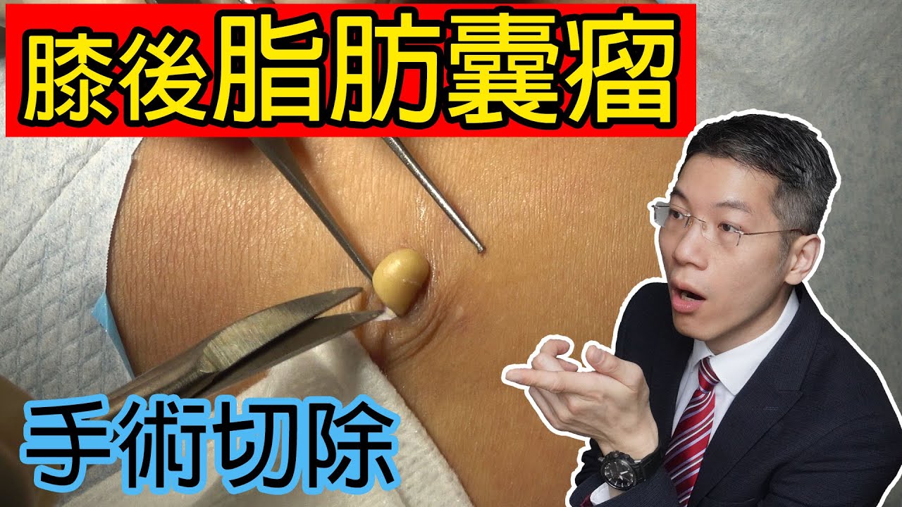 膝後脂肪囊瘤