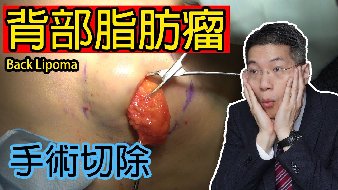背部脂肪瘤