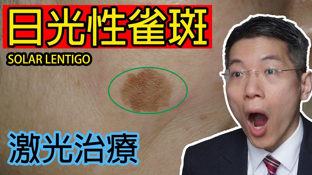日光性雀斑