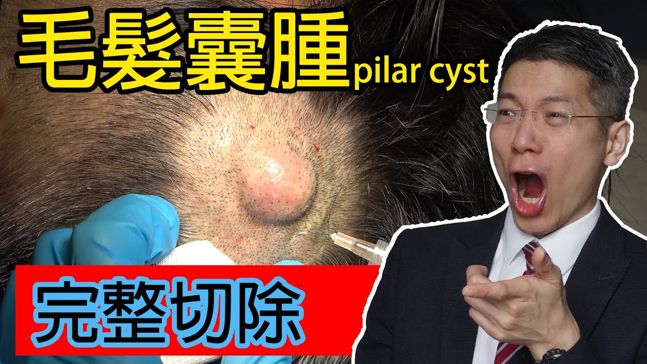 頭皮毛髮囊腫