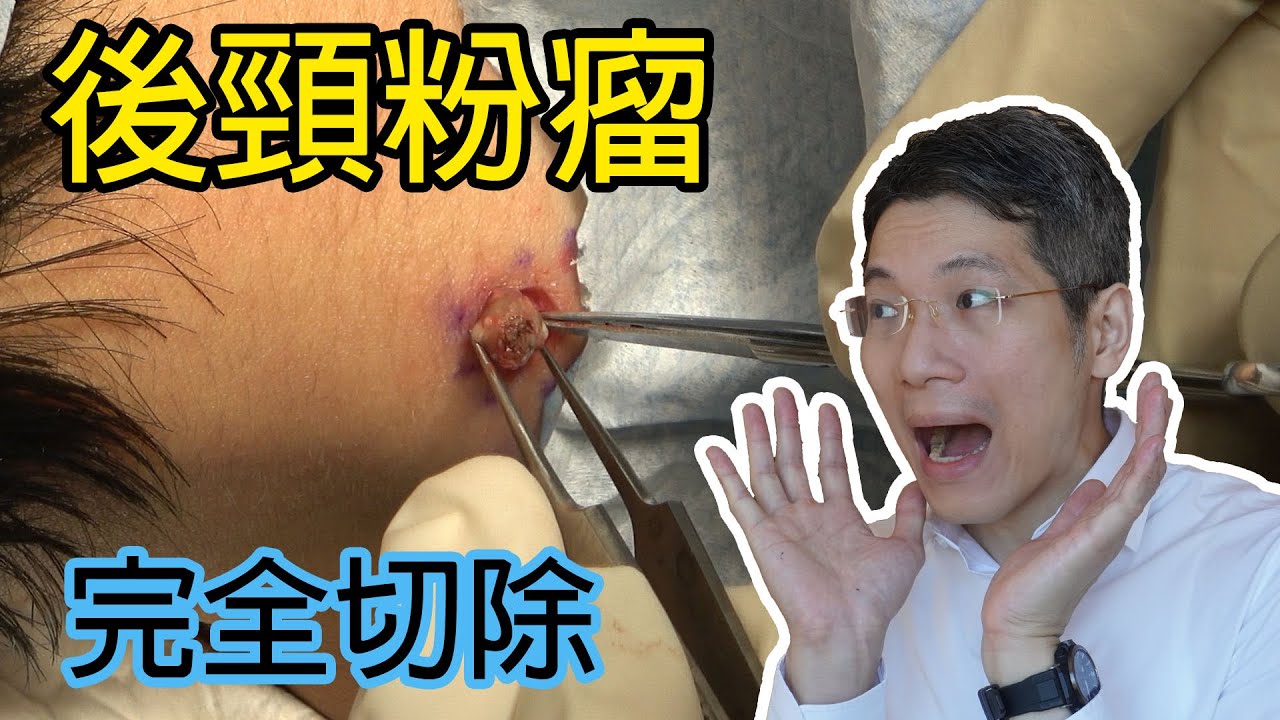 後頸粉瘤