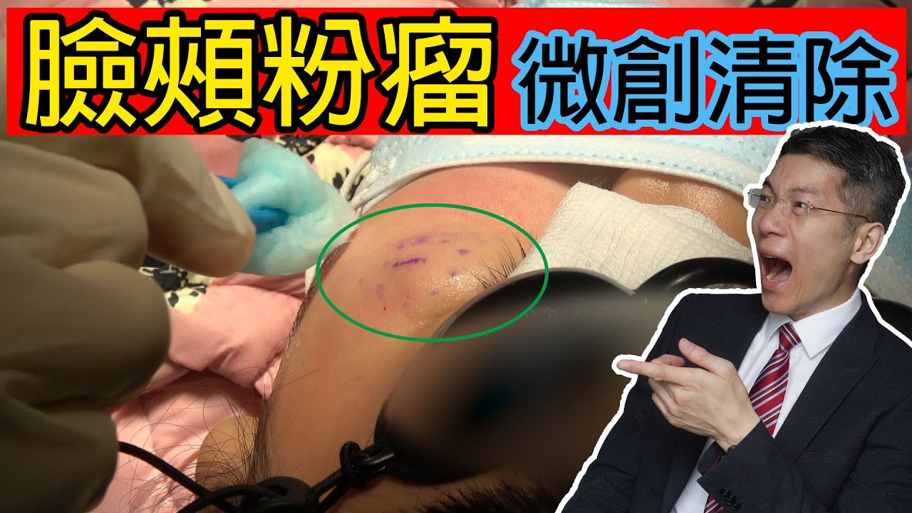臉頰粉瘤微創清除