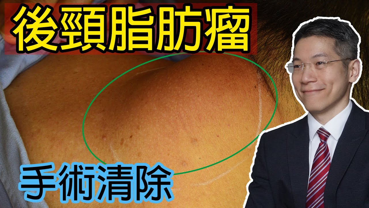 後頸脂肪瘤