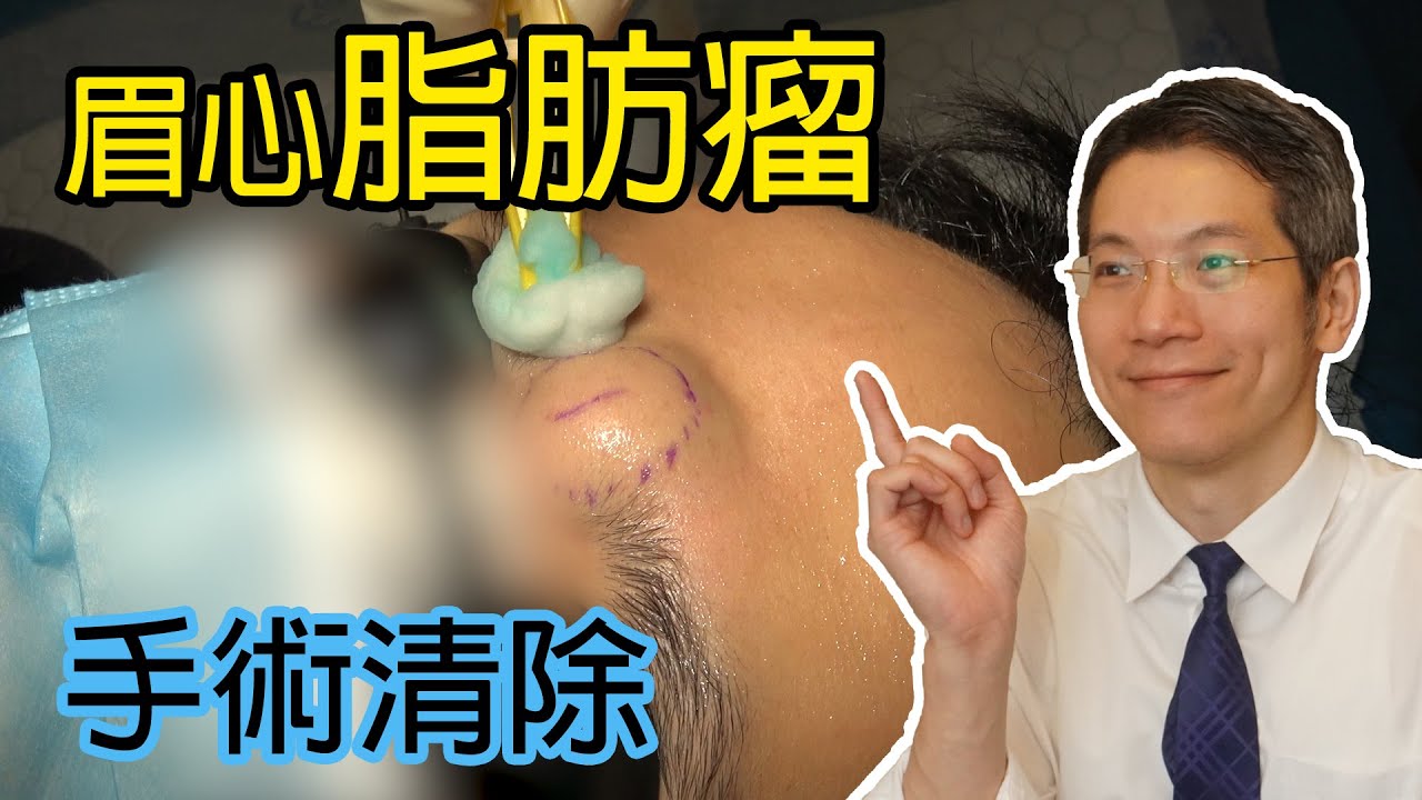 眉心脂肪瘤