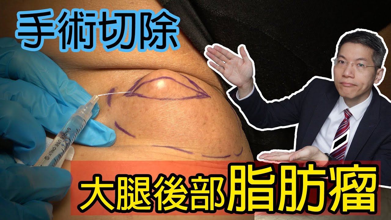 大腿後部脂肪瘤