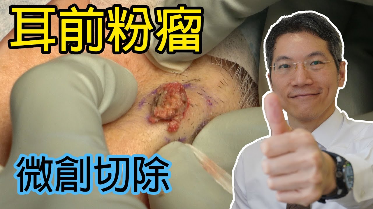 耳前粉瘤微創切除