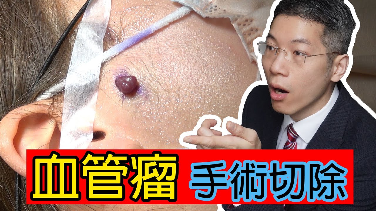 血管瘤手術切除
