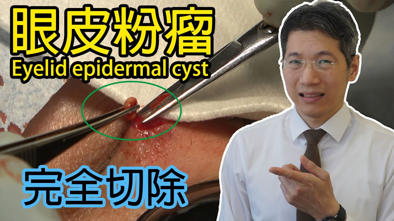 眼皮粉瘤