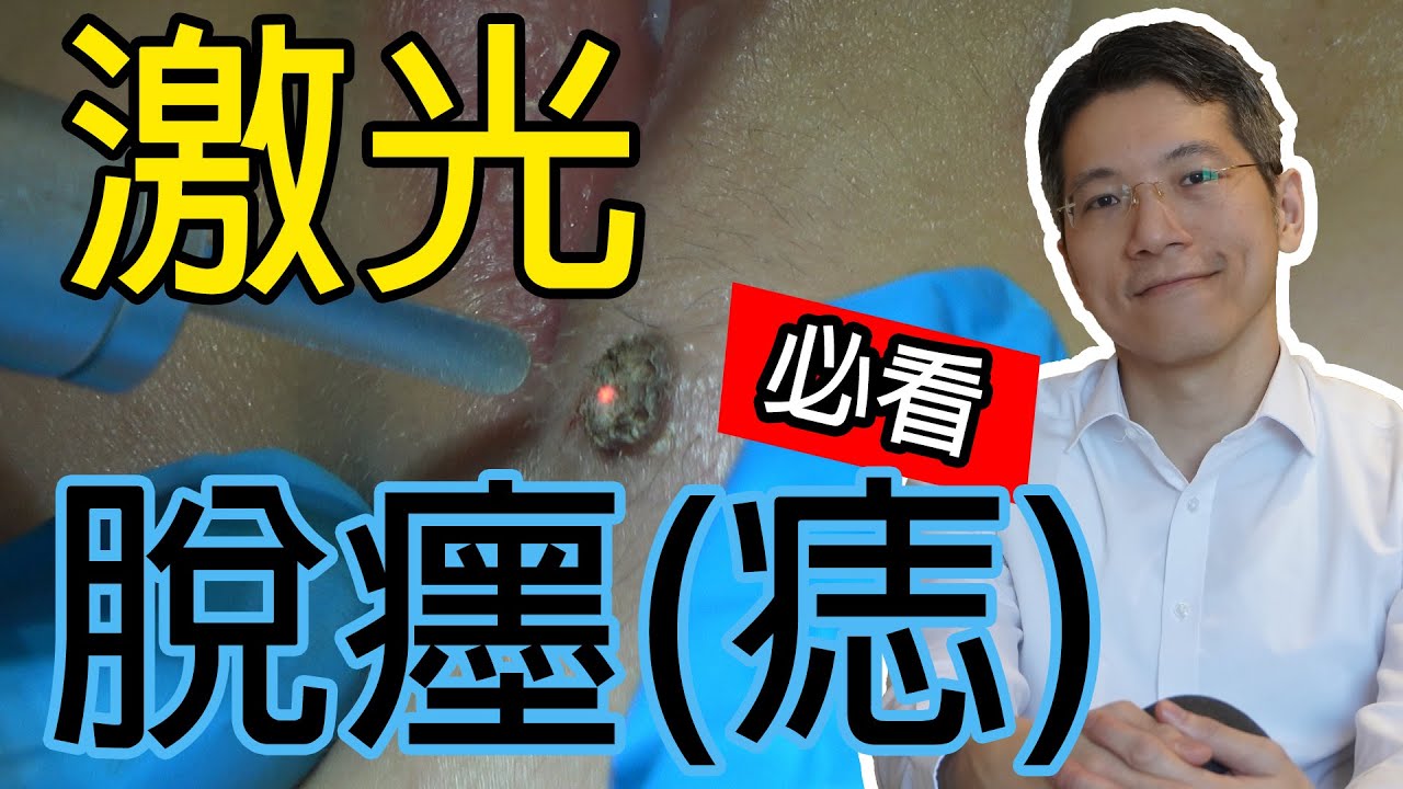 激光脫癦（痣）必看