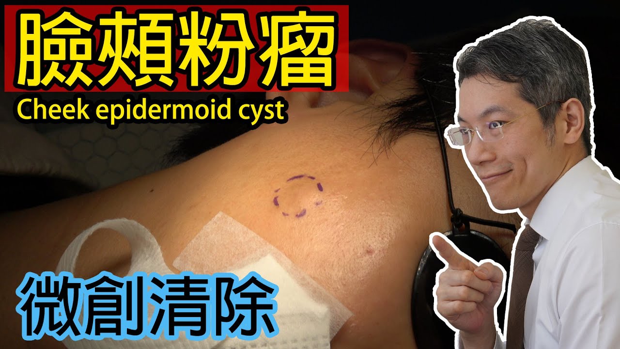 臉頰粉瘤 微創取出