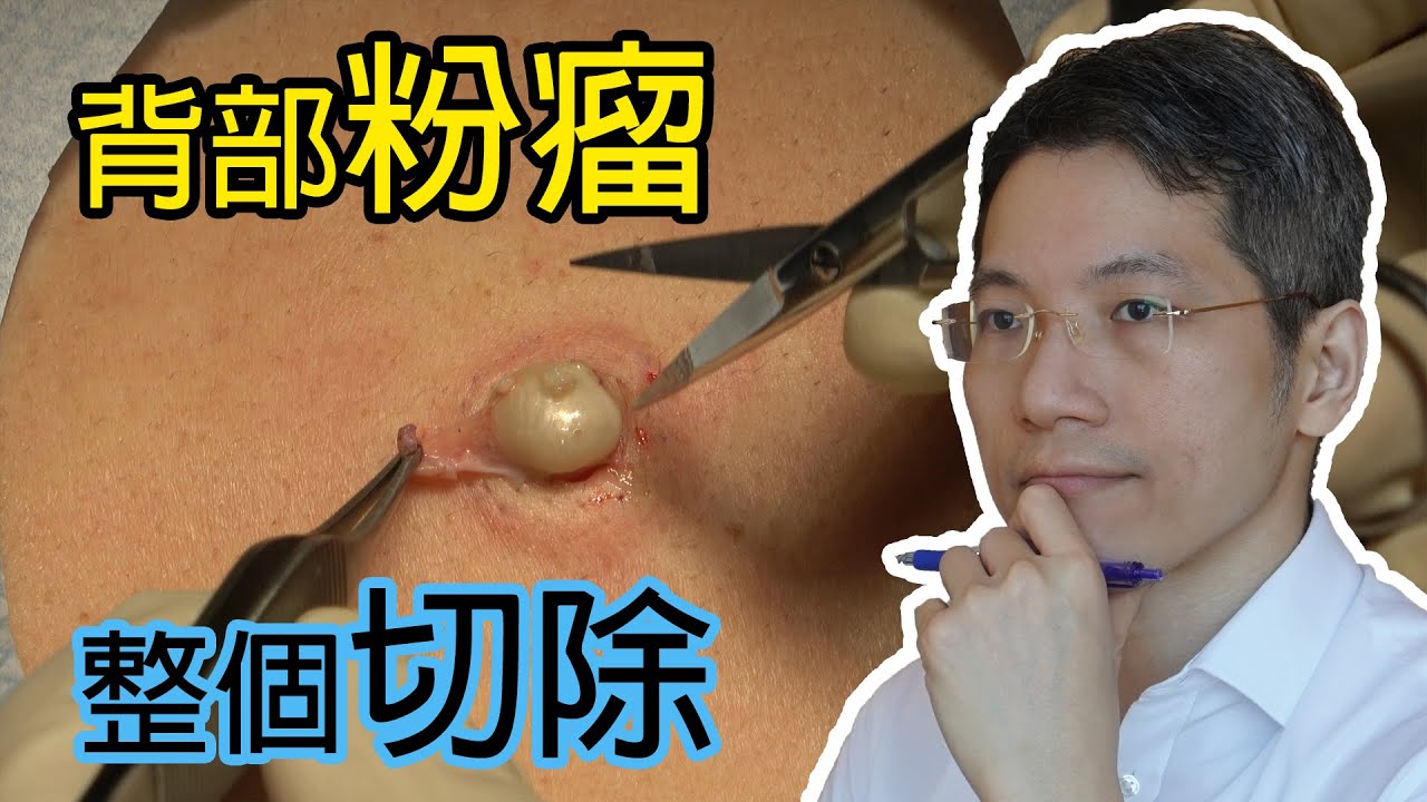 背部粉瘤整個切除