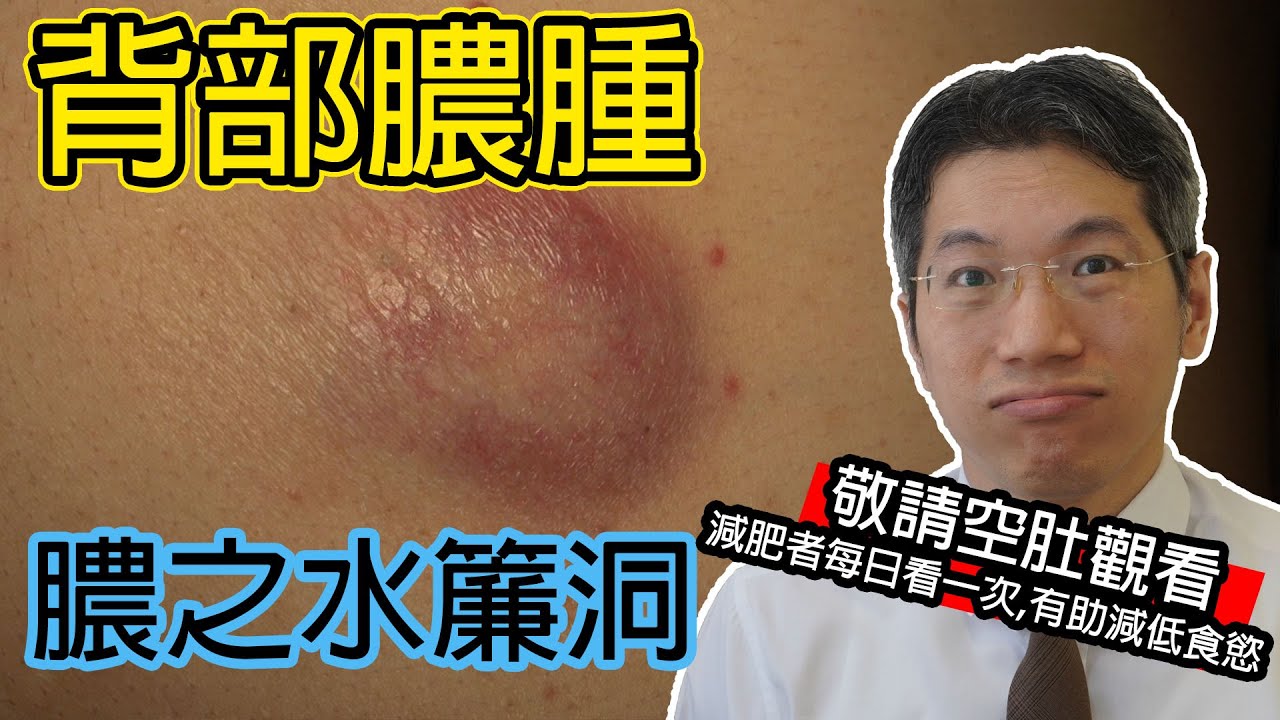 背部膿腫 膿之水簾洞