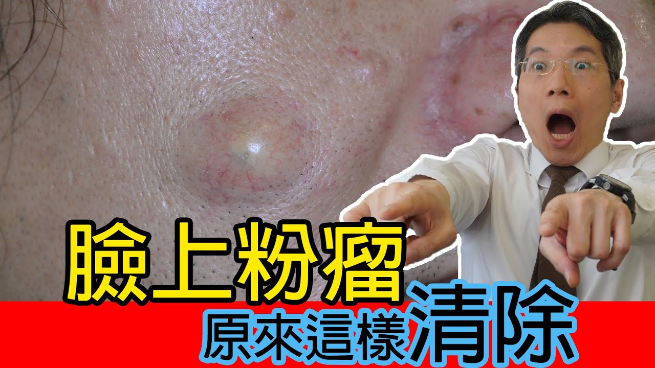 臉上粉瘤 原來這樣清除