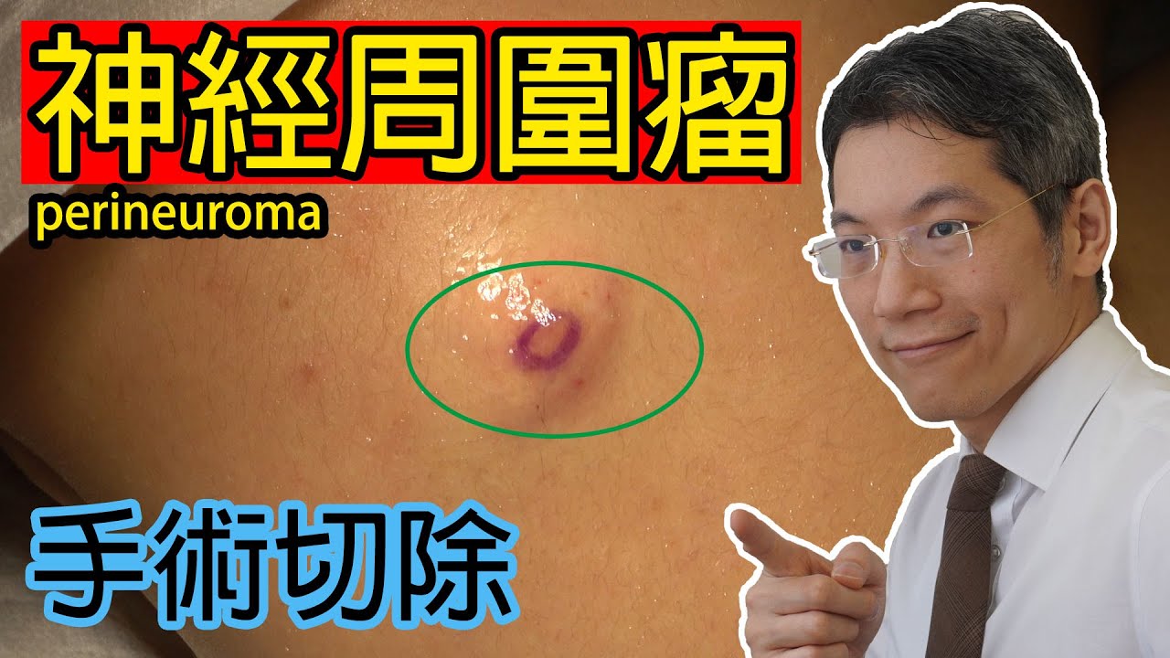 神經周圍瘤 手術切除