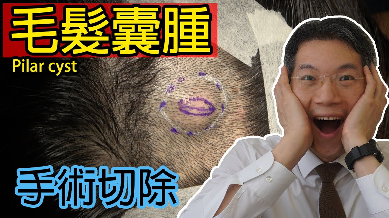 毛髮囊腫 手術切除