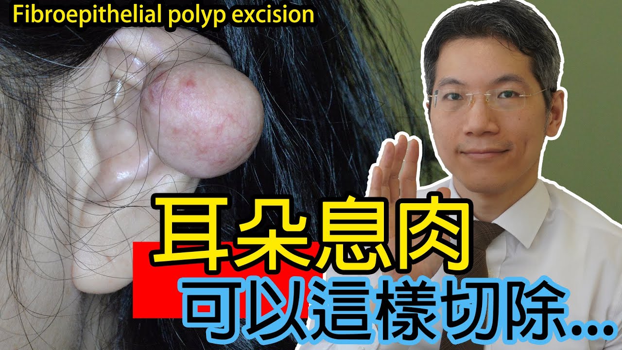 耳朵息肉 可以這樣切除