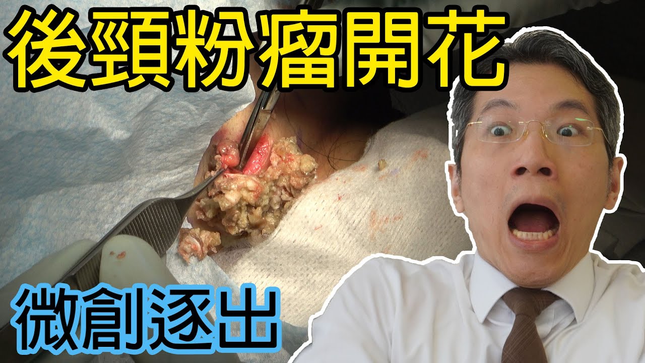 後頸粉瘤微創手術清除