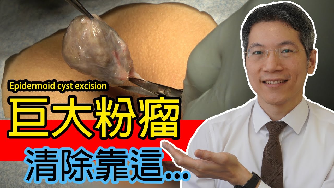 巨大粉瘤 清除靠這