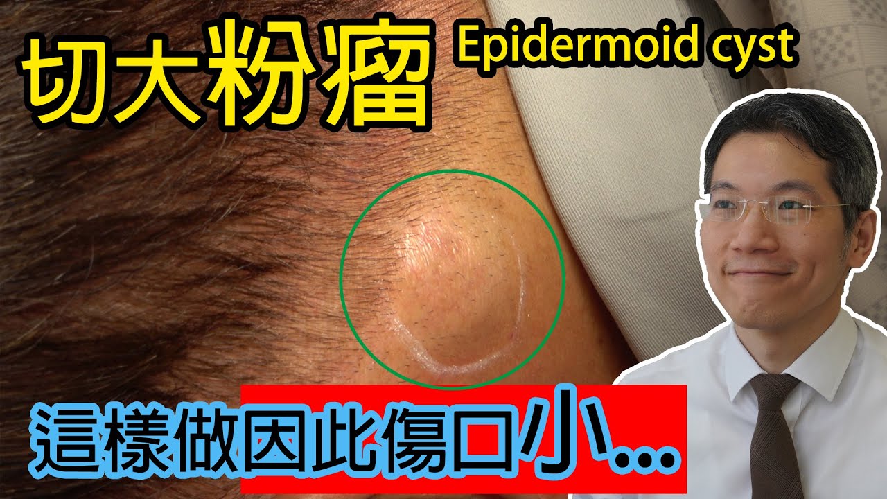 切大粉瘤 這樣做因此傷口小