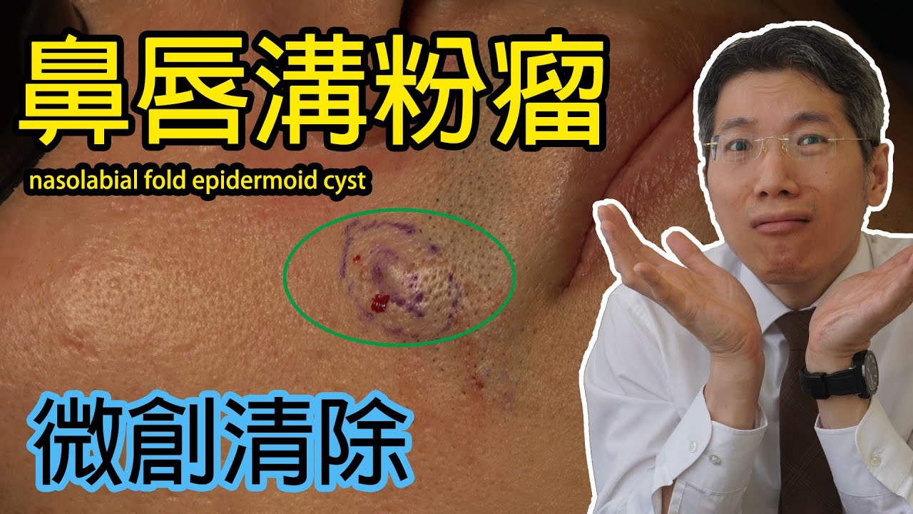 鼻唇溝粉瘤 微創
