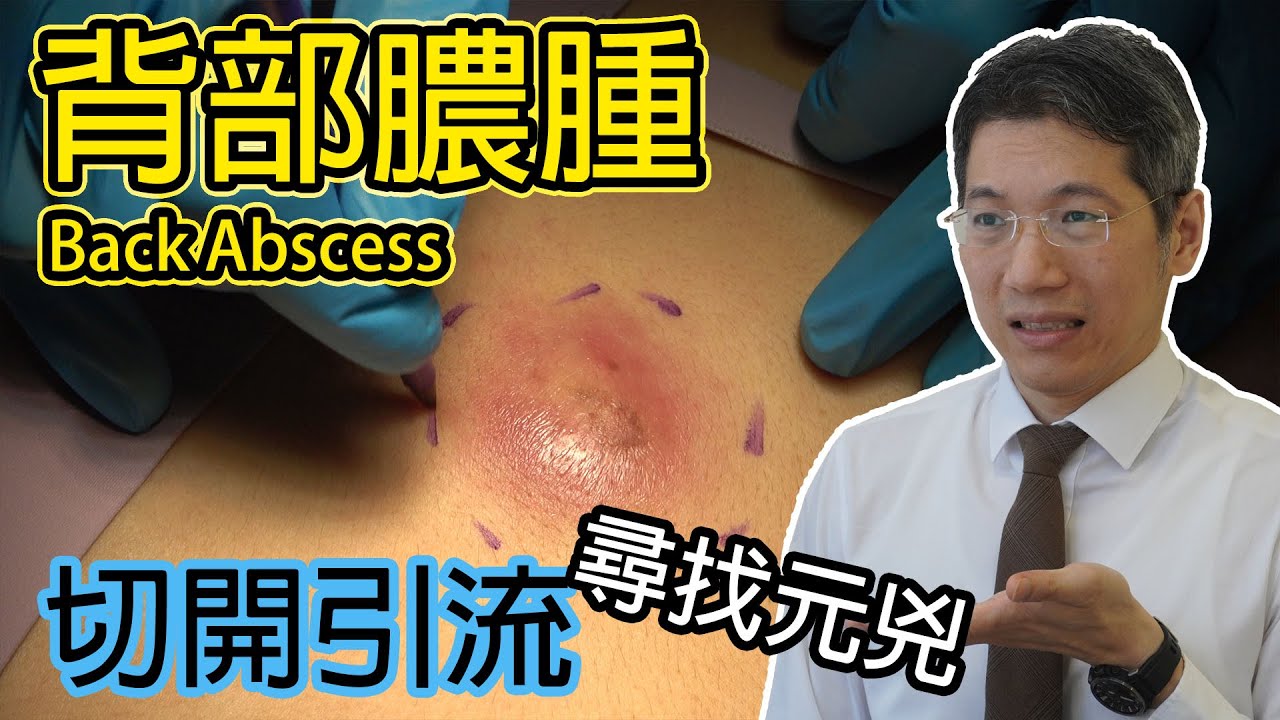 背部膿腫 切開引流 尋找元凶