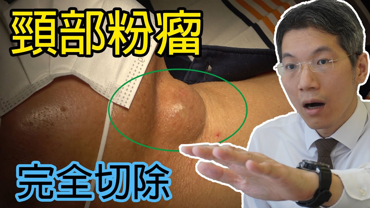 頸部巨大粉瘤切除術