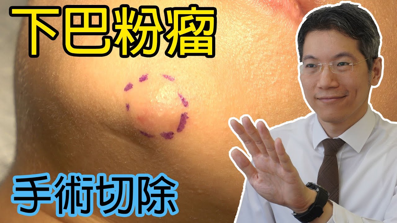 下巴粉瘤 手術切除