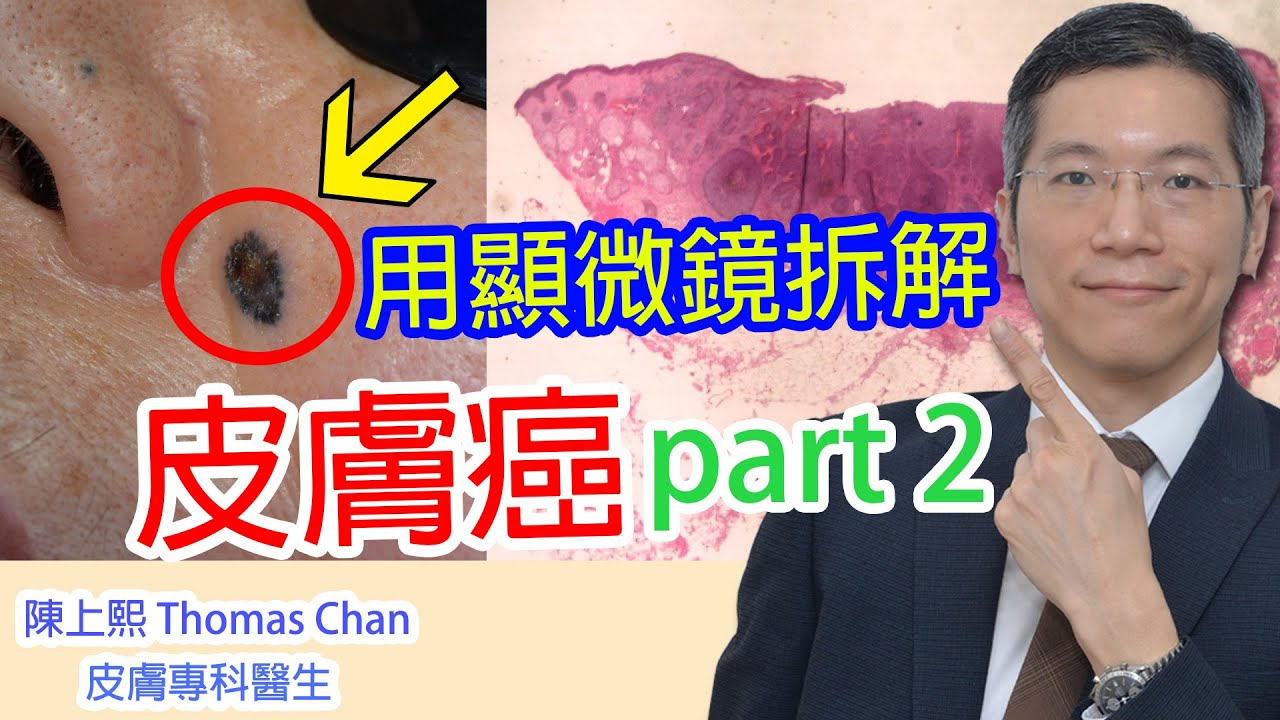 皮膚癌下集
