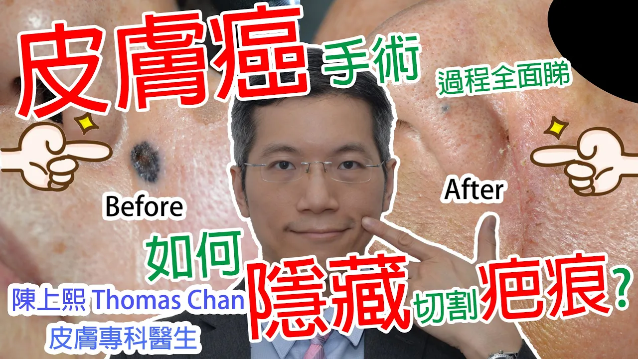 皮膚癌 基底細胞皮膚癌術後疤痕一定很明顯?