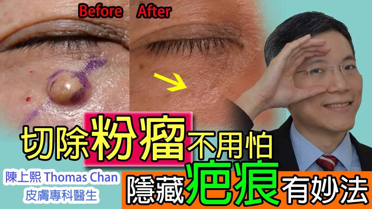粉瘤如何切除?