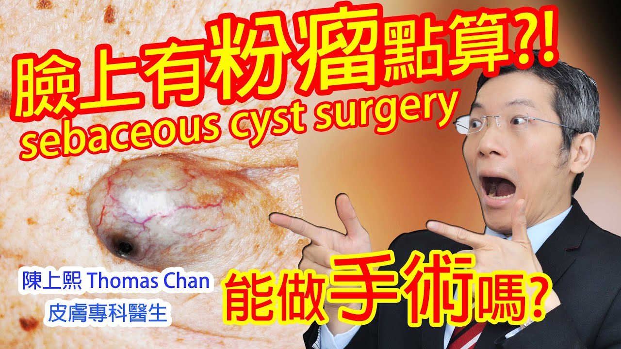 臉上有粉瘤點算？