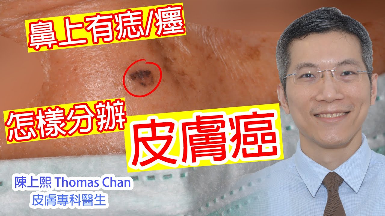 基底細胞皮膚癌 怎樣分辨皮膚癌
