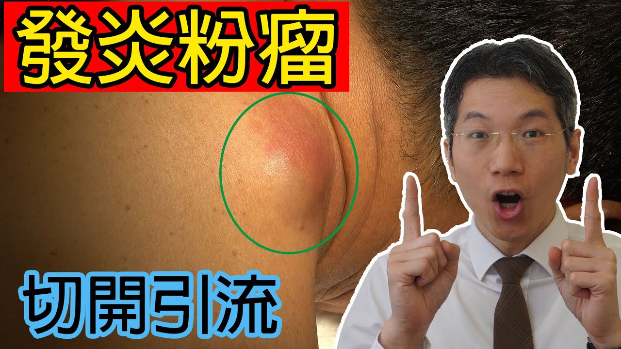 發炎粉瘤 切開引流