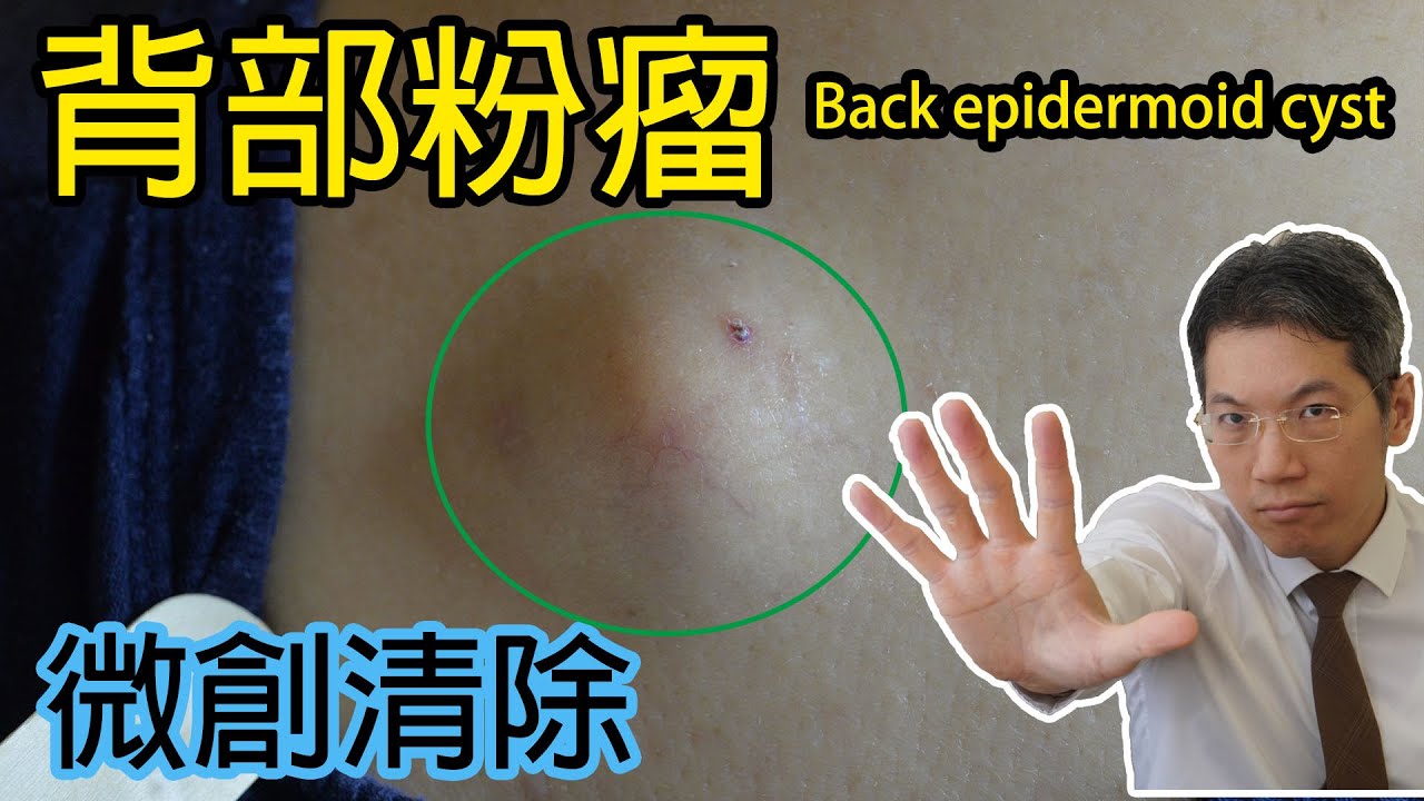 背部粉瘤