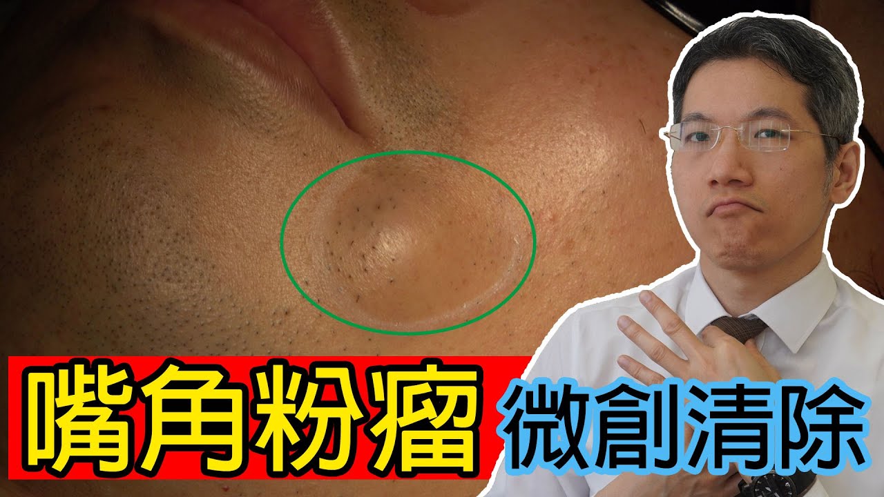 嘴角粉瘤 取出