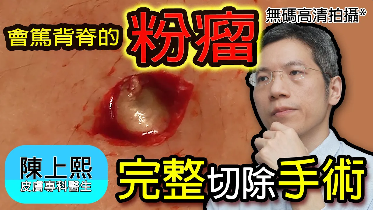 背部長粉瘤完整去除