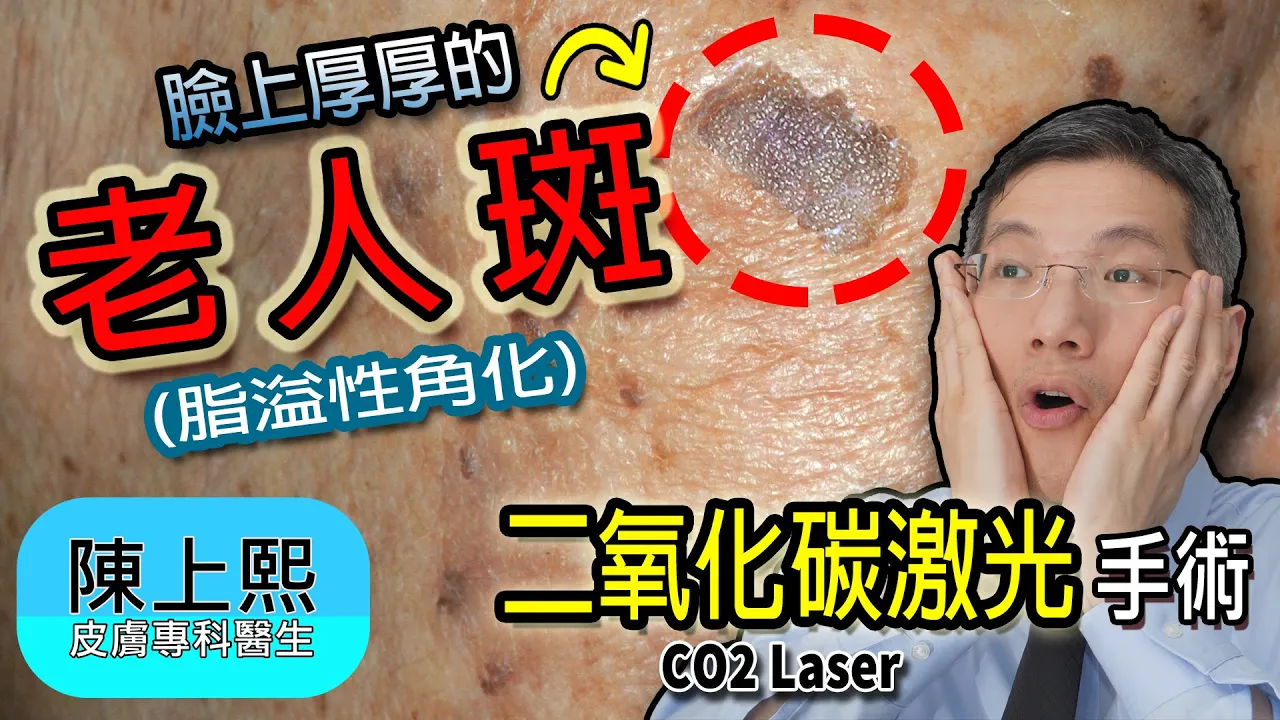 老人斑  脂溢性角化