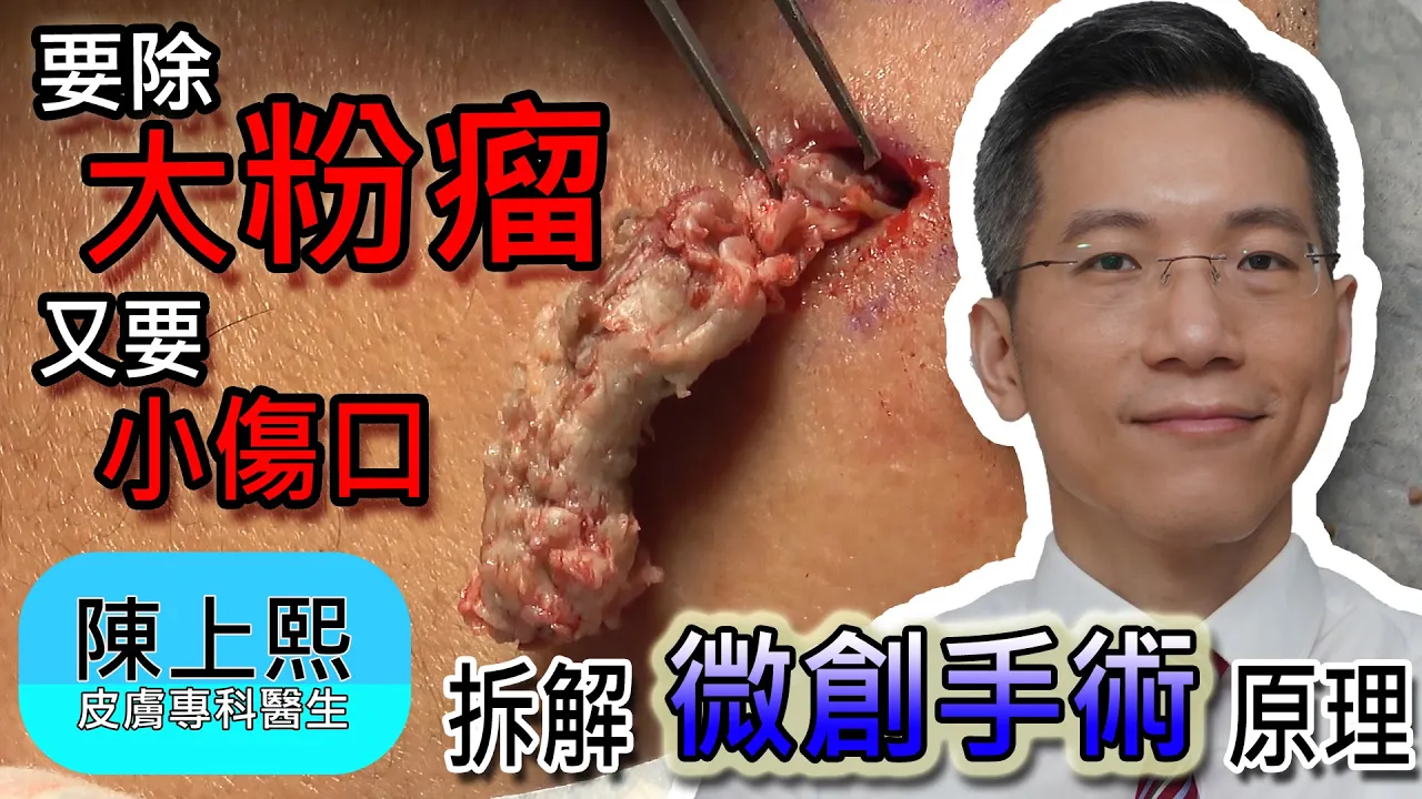 臉上粉瘤 微創手術