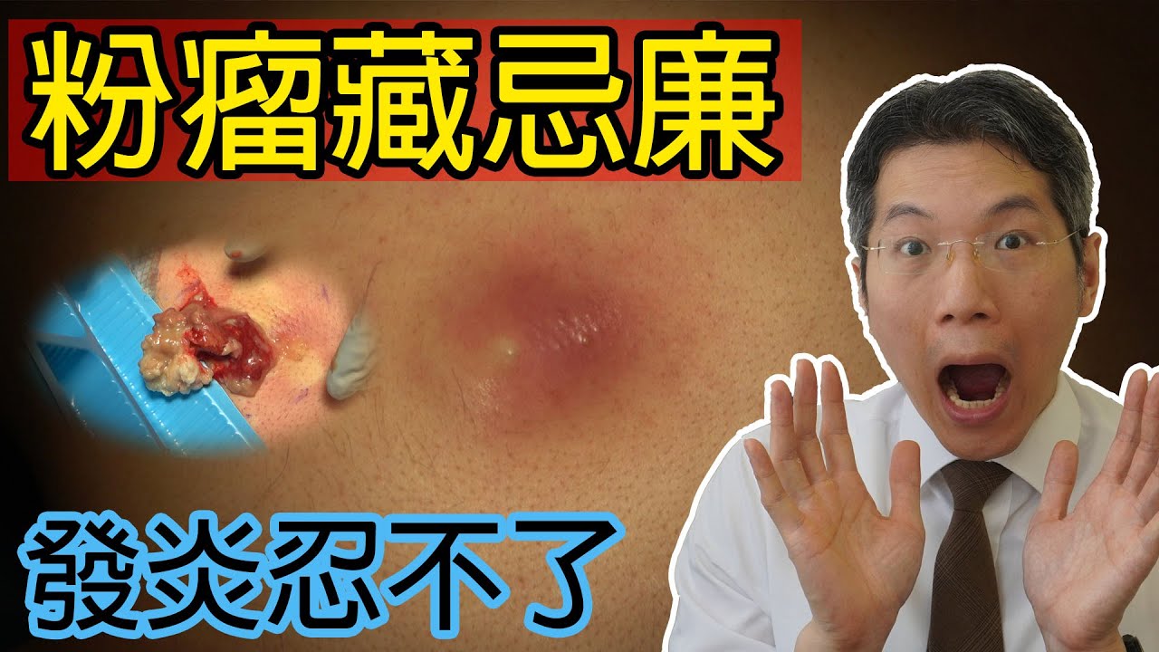 粉瘤藏忌廉