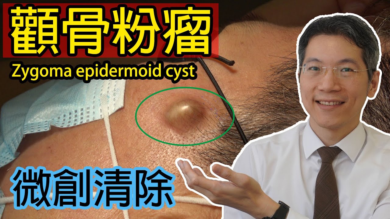 顴骨粉瘤