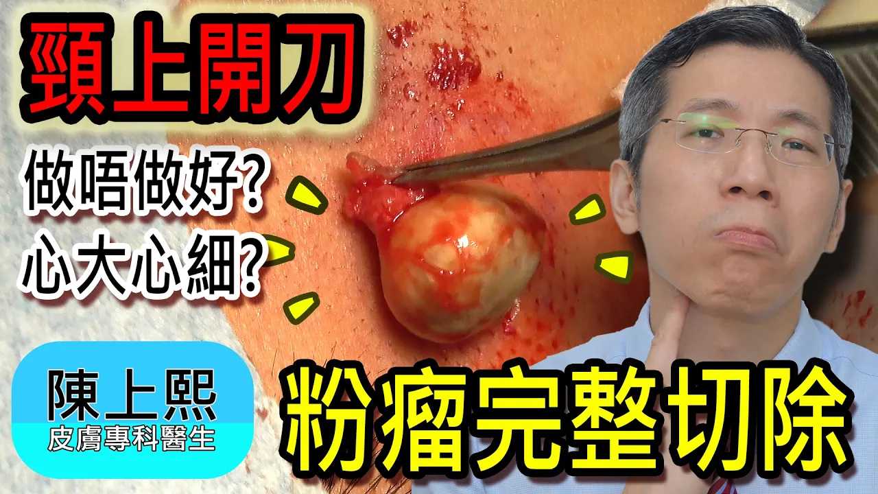 頸上腫塊愈來愈大是粉瘤作怪嗎？